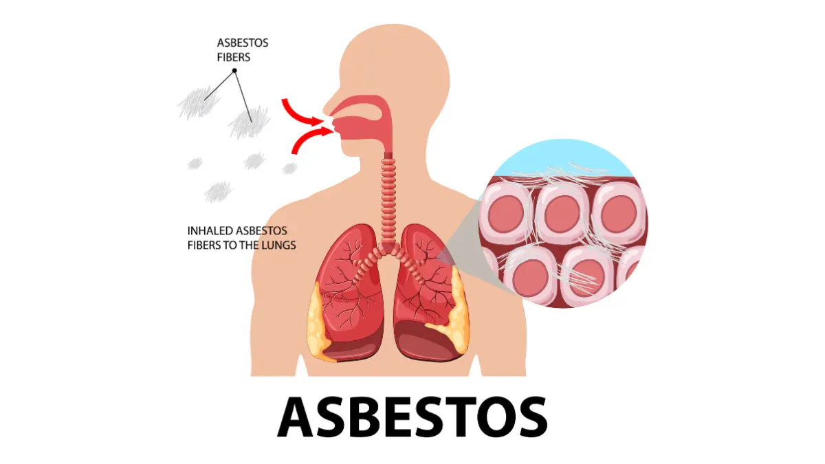 Medical diagram showing asbestos fibers being inhaled into lungs and lodging in pleural tissue causing mesothelioma cancer