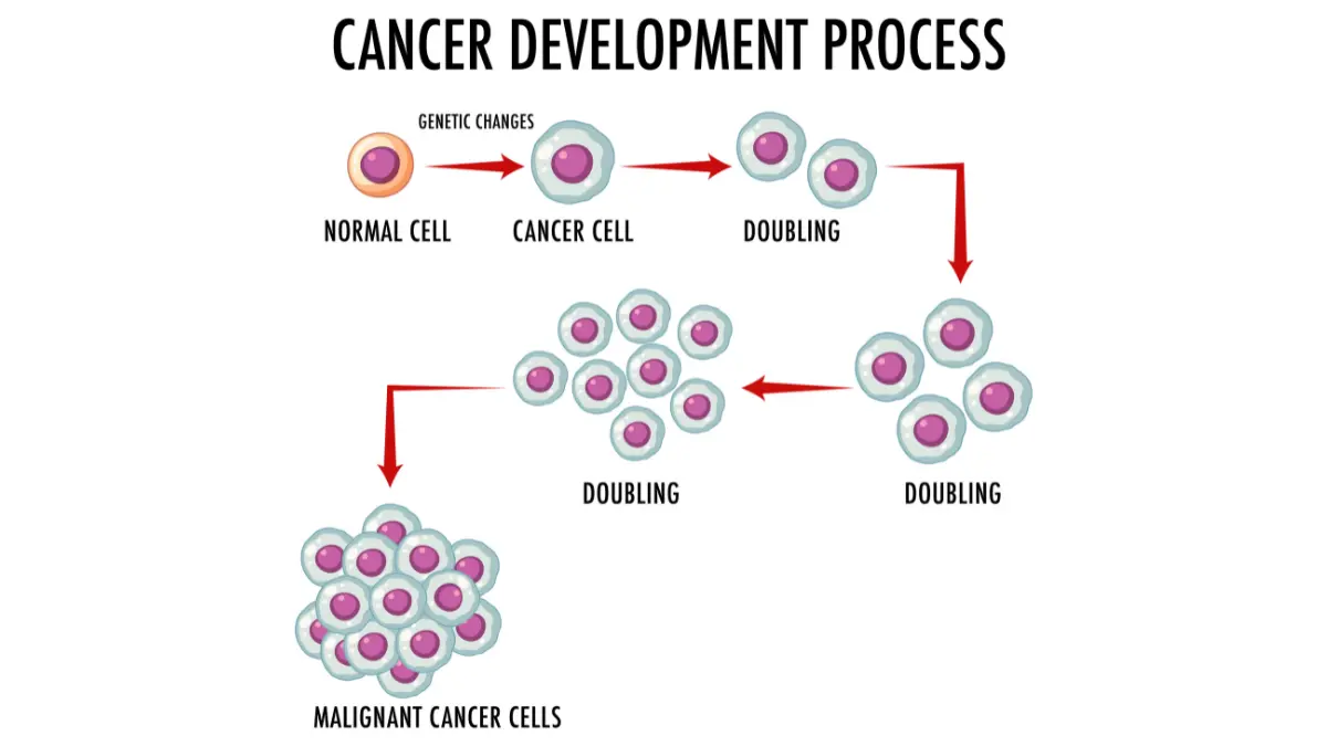 Medical diagram showing mesothelioma cancer progression from Stage 1 localized tumor to Stage 4 metastatic spread