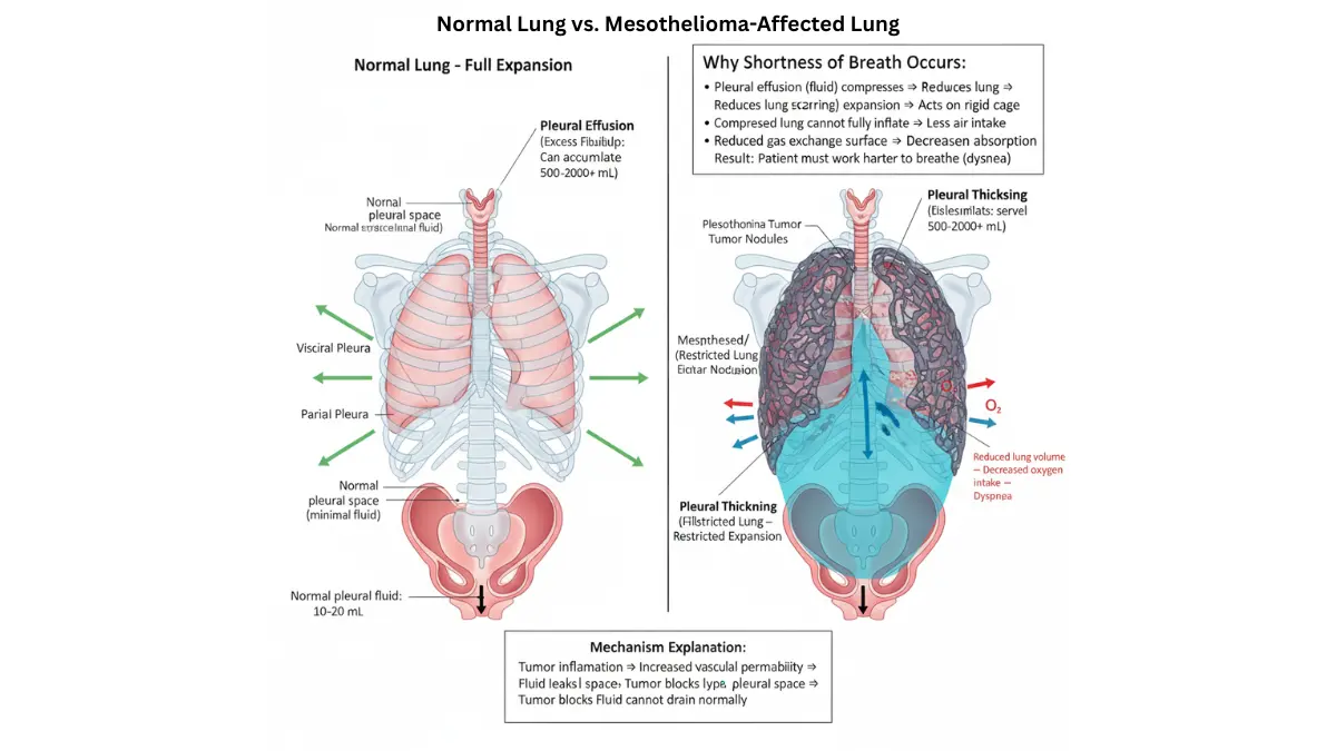Vector illustration showing pleural effusion and lung restriction in mesothelioma