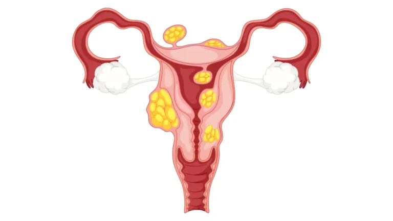 Medical vector illustration of female reproductive system showing ovaries and uterus for PCOS symptoms in women