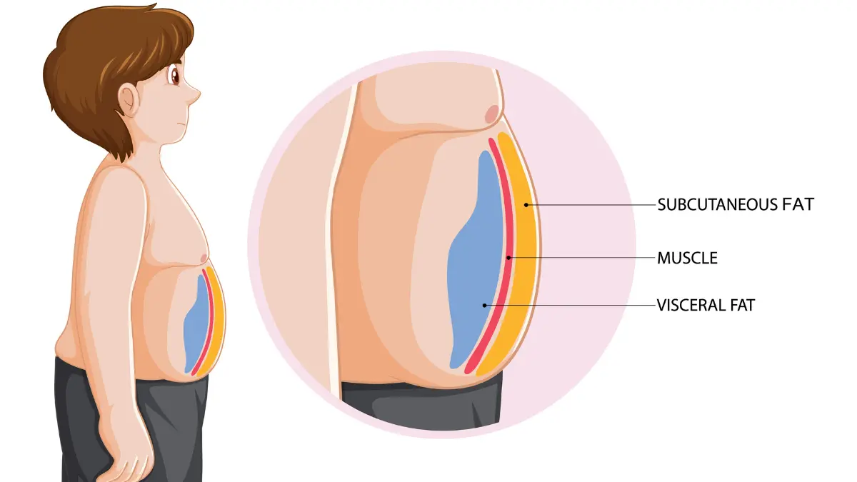 Medical diagram showing visceral fat around organs versus subcutaneous fat under skin with cardiovascular risk indicators
