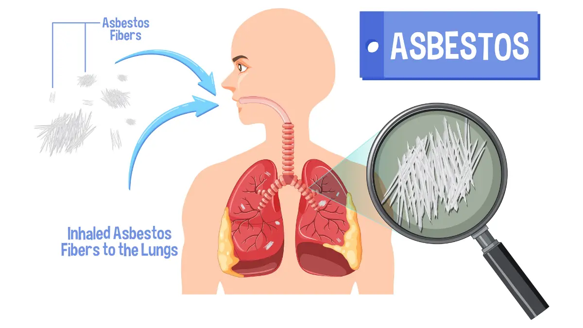 Medical illustration showing asbestos fibers causing mesothelioma cancer in lung tissue with cellular damage mechanism