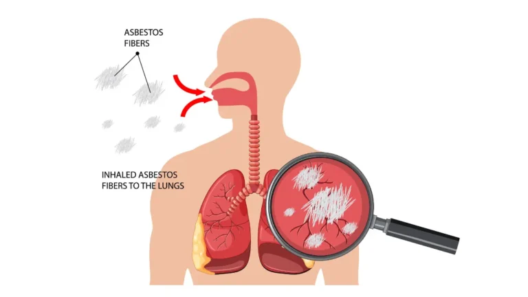 Medical diagram showing asbestos fibers being inhaled into human lungs with magnified view of fiber particles causing respiratory damage