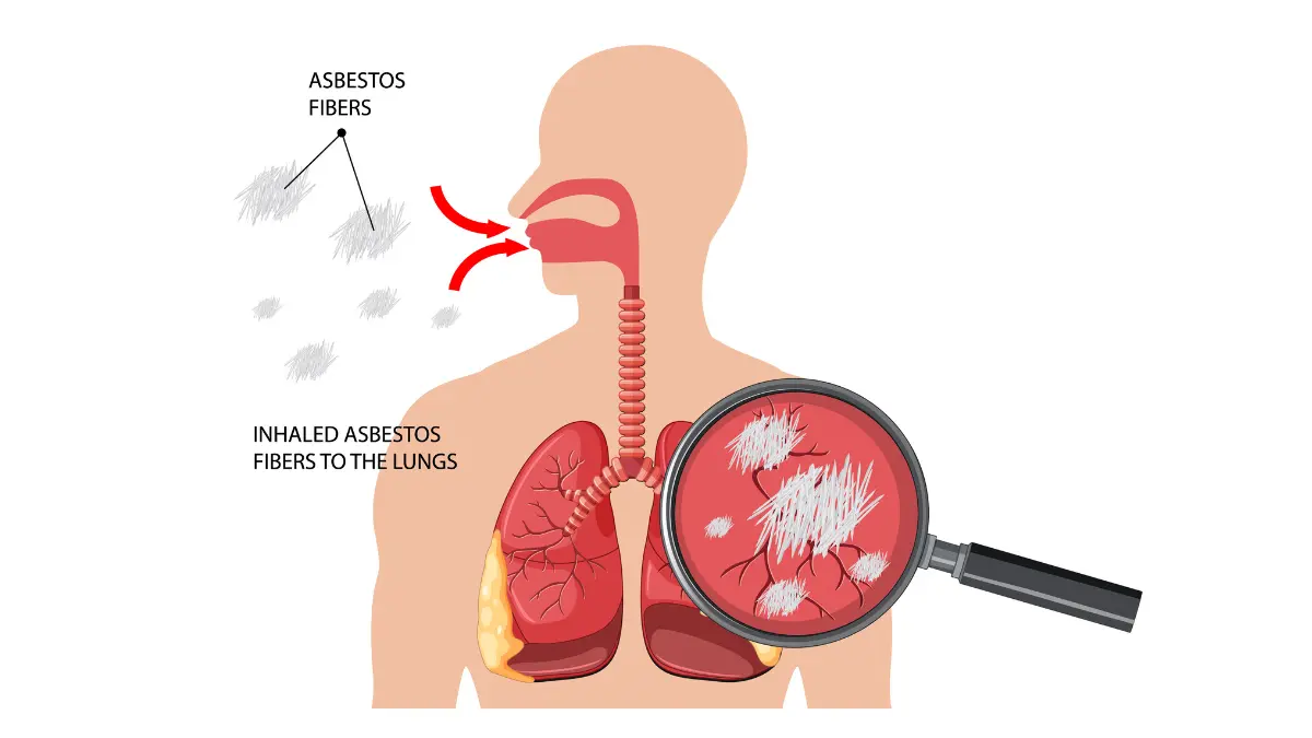 Medical diagram showing asbestos fibers being inhaled into human lungs with magnified view of fiber particles causing respiratory damage
