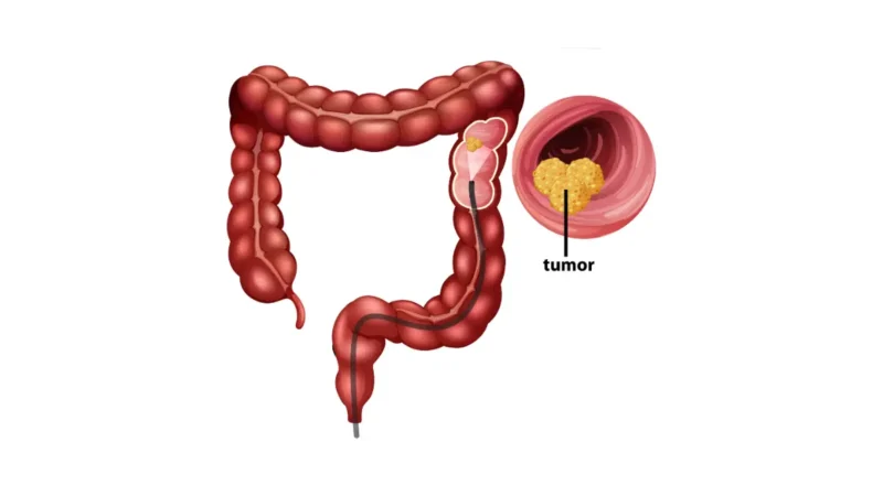 Bowel Cancer Symptoms shown in a colorectal cancer anatomy diagram highlighting tumor location
