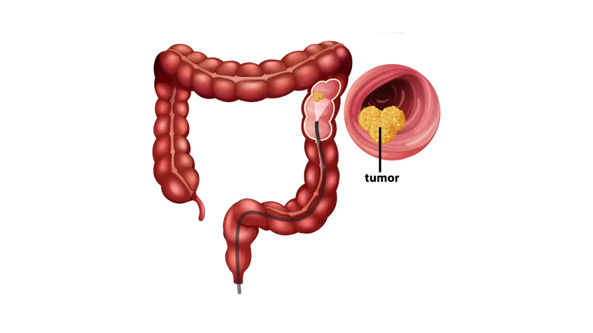 Bowel Cancer Symptoms shown in a colorectal cancer anatomy diagram highlighting tumor location