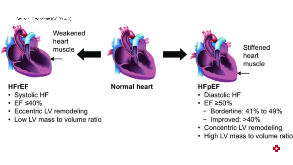 Ejection fraction heart failure types diagram showing HFrEF (reduced EF) and HFpEF (preserved EF) with weakened and stiff heart muscle differences