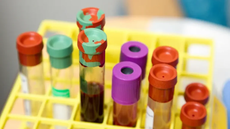Blood sample tubes in a laboratory rack used for ESR Test Results analysis