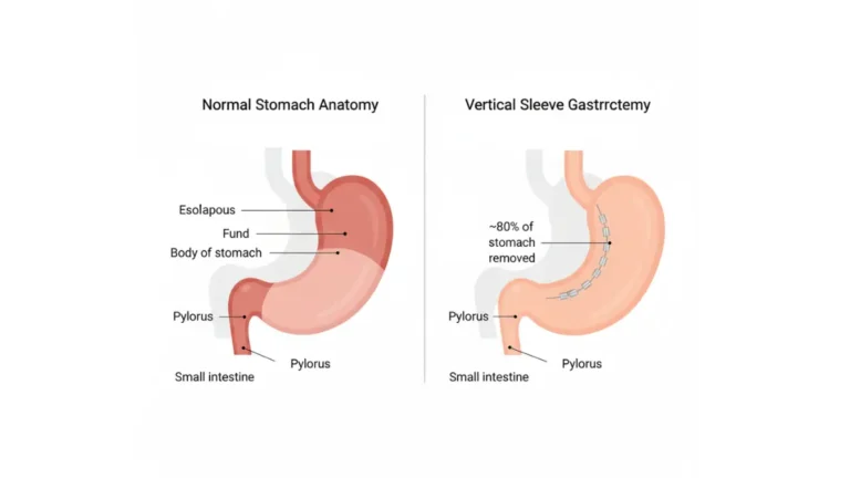 gastric sleeve surgical procedure diagram showing stomach before and after vertical sleeve gastrectomy