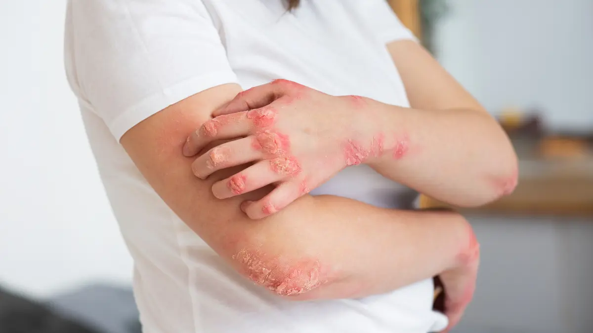 Measles Outbreak showing red inflammatory skin rash on arms and hands during active infection