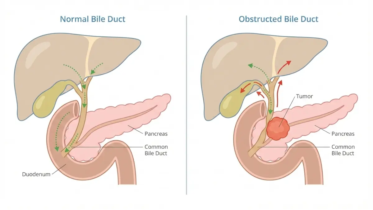 Pancreatic cancer symptoms shown through bile duct obstruction caused by pancreatic tumor