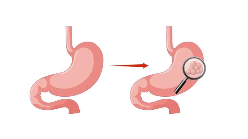 Stomach Cancer Symptoms illustrated through cancer development process from normal cells to malignant tumor