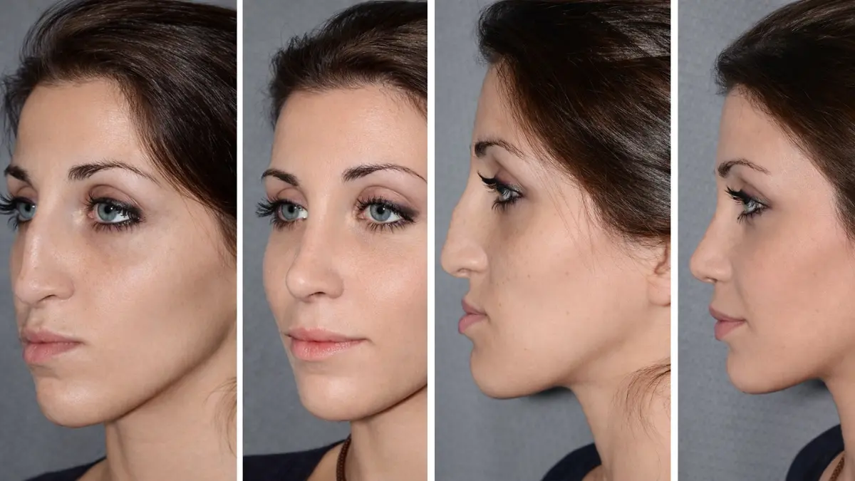 Nose Job before and after photos showing facial profile changes from multiple angles