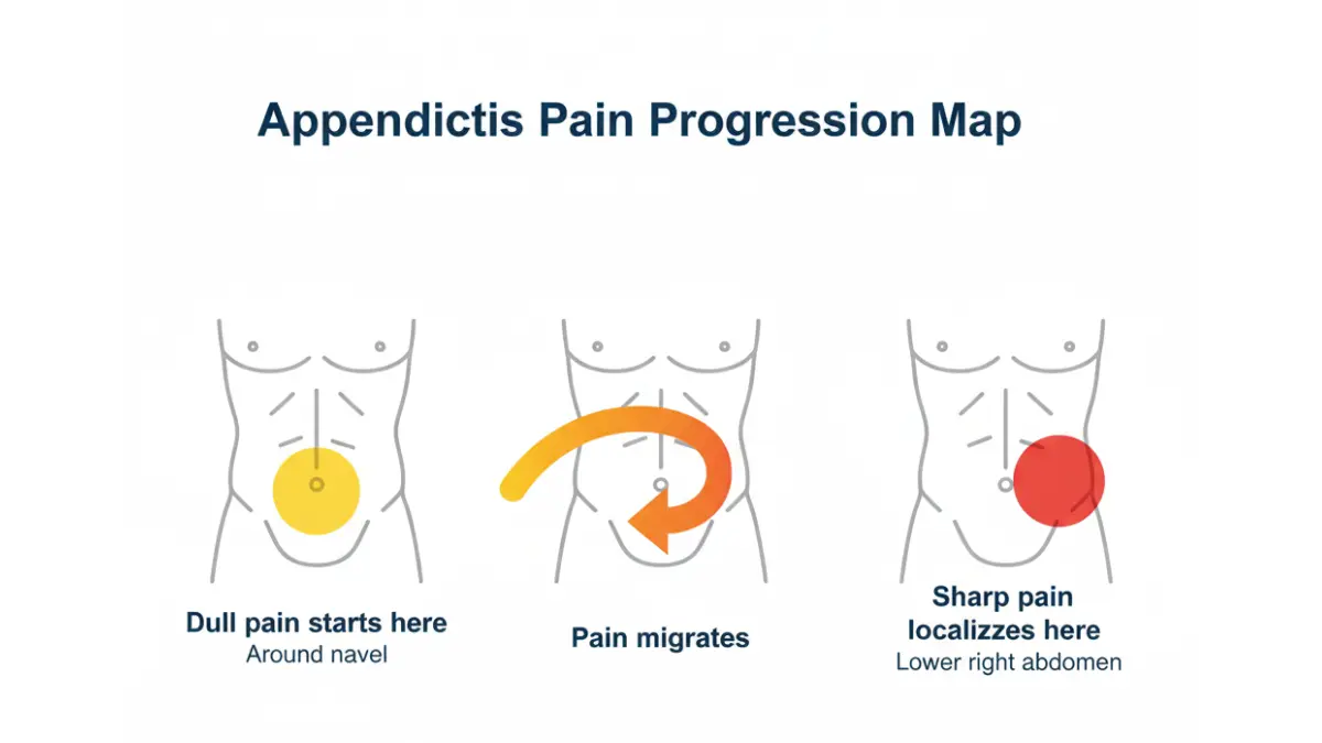 Appendectomy symptom diagram showing appendicitis pain progression from belly button to lower right abdomen over 24 hours