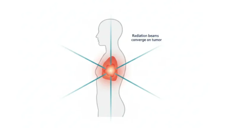 Radiation Therapy beams converging precisely on a chest tumor inside human body anatomy diagram