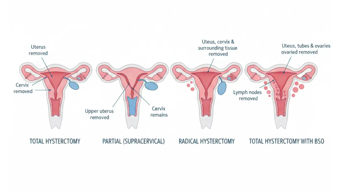 Hysterectomy anatomical comparison diagram showing differences between total, partial, radical hysterectomy and hysterectomy with bilateral salpingo-oophorectomy