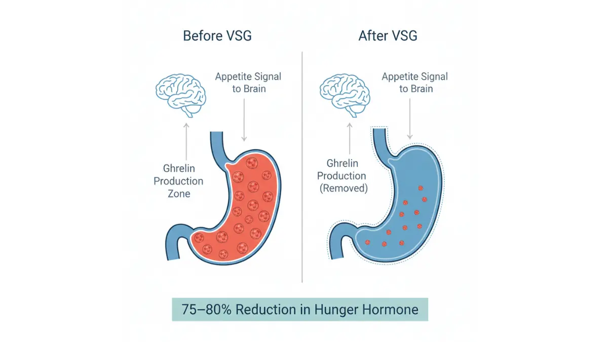 Medical anatomy diagram showing ghrelin hormone production in stomach fundus before and after VSG Surgery