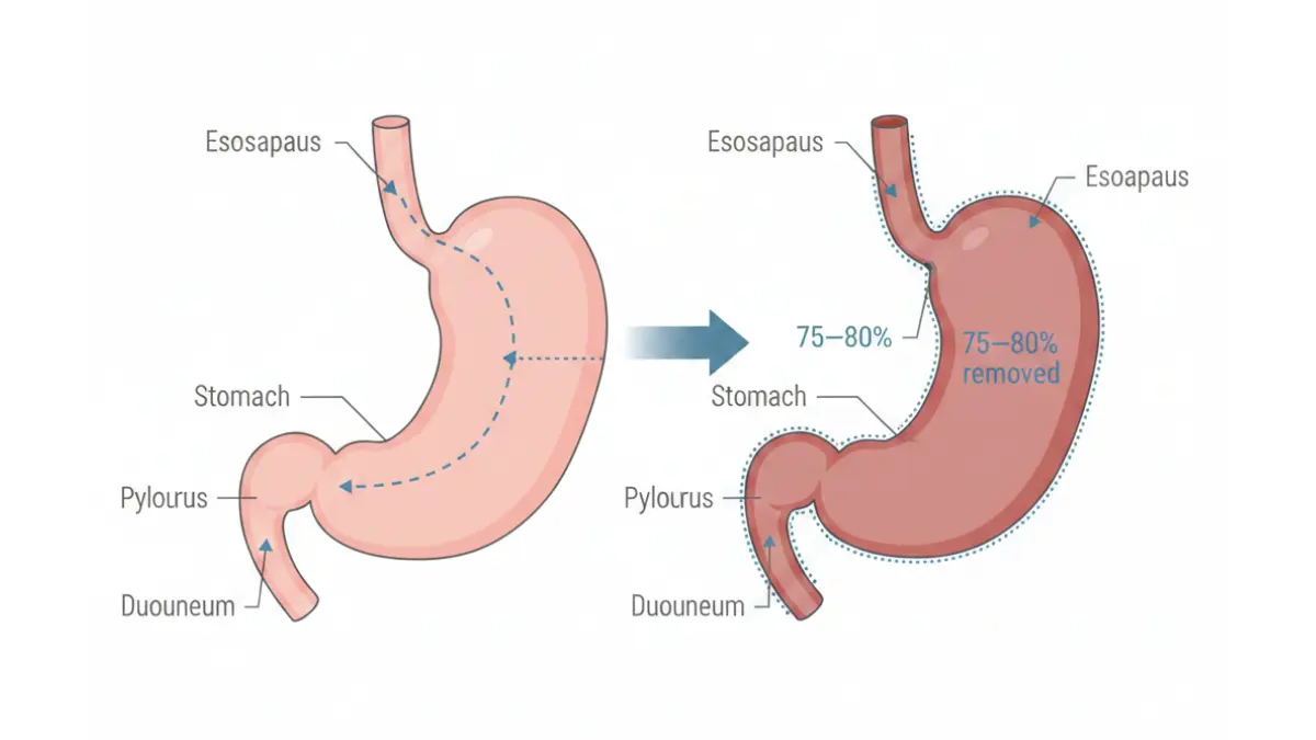 Medical anatomy diagram showing VSG Surgery stomach comparison before and after vertical sleeve gastrectomy procedure