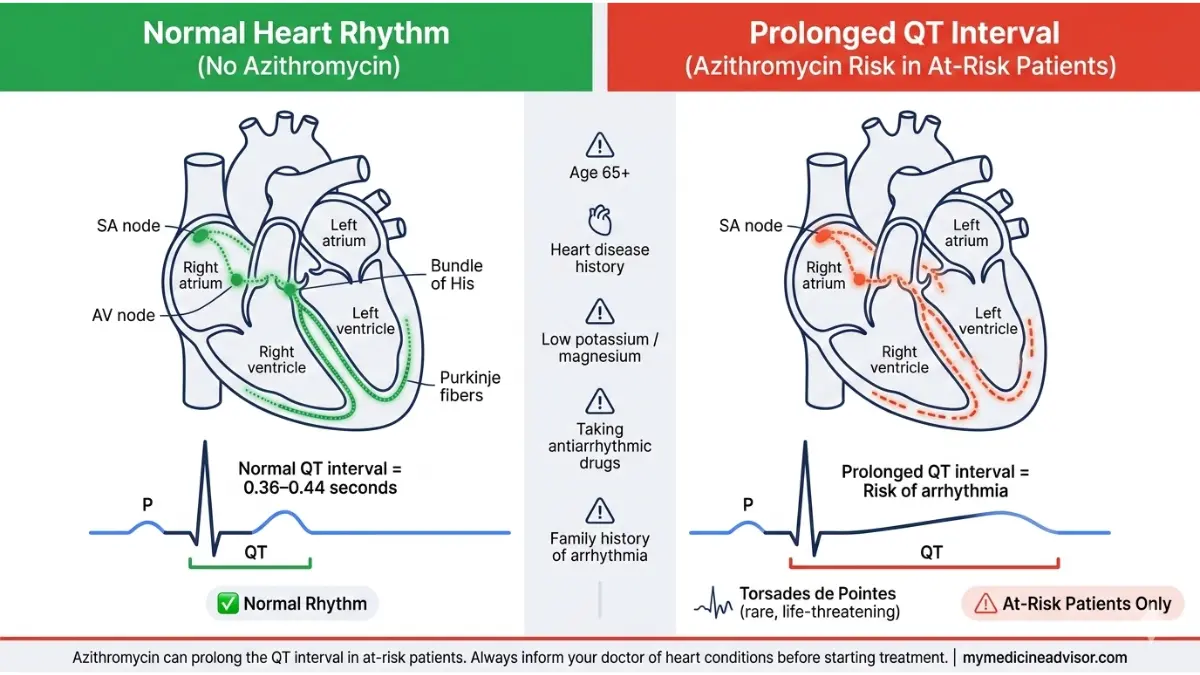 Azithromycin QT prolongation diagram comparing normal heart rhythm and prolonged QT interval with ECG waveform differences and arrhythmia risk