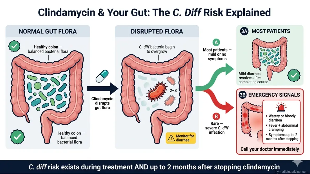 Clindamycin gut microbiome disruption diagram showing how Clindamycin leads to C difficile overgrowth and infection risk in the colon