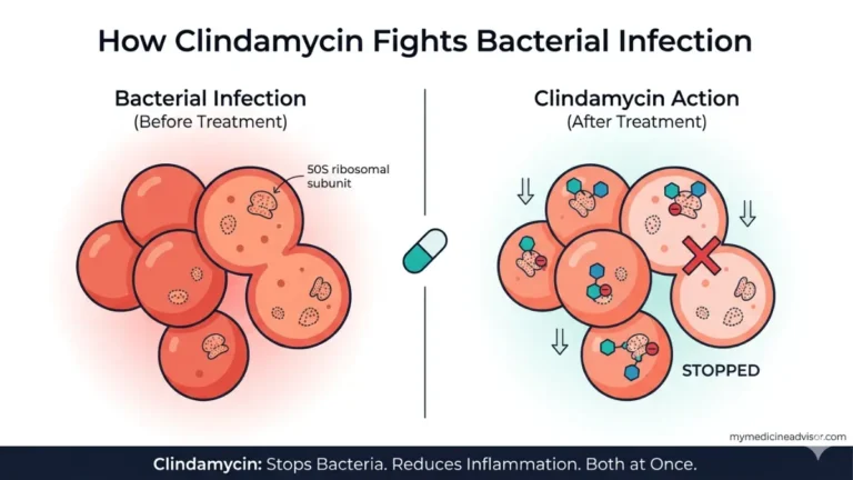 Clindamycin mechanism of action diagram showing Clindamycin binding to 50S ribosomal subunit blocking bacterial protein synthesis and reducing inflammation