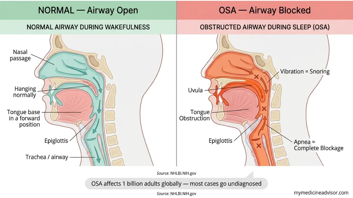 Home Sleep Apnea Test airway diagram showing normal breathing vs obstructed airway in sleep apnea