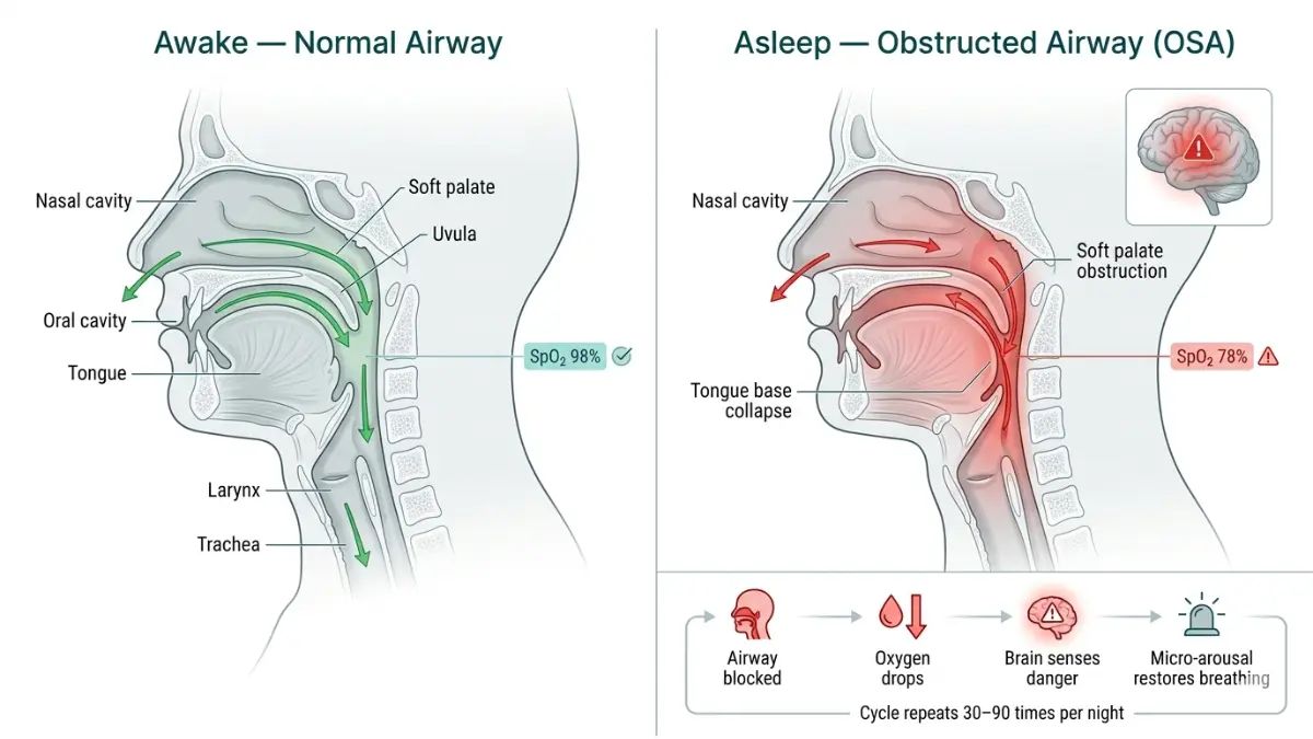 Sleep Disorder anatomy diagram showing obstructive sleep apnea with airway blockage tongue collapse and low oxygen levels
