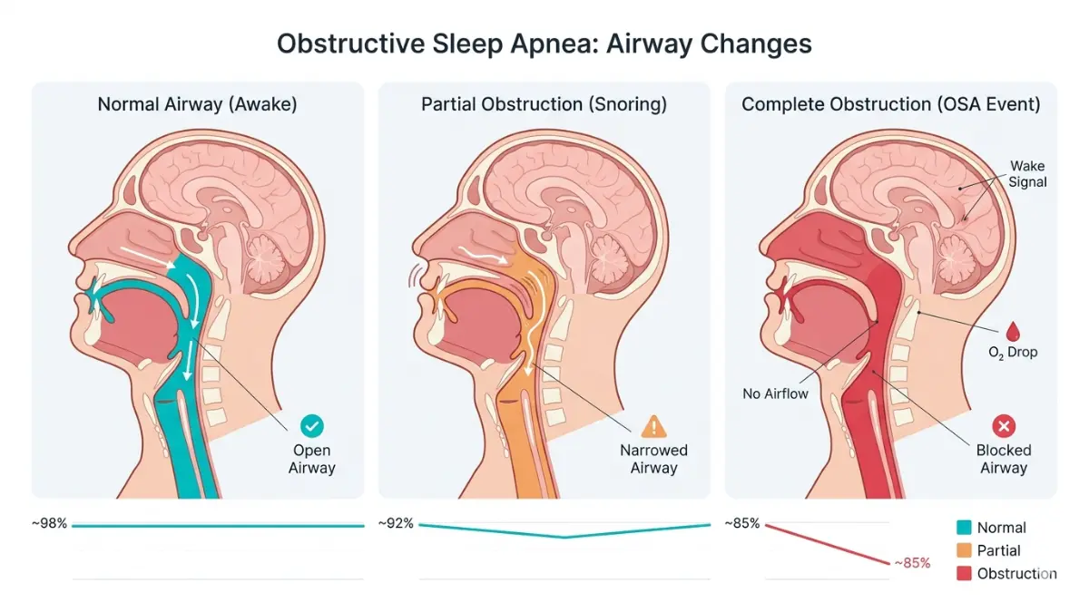 Sleep Disorder obstructive sleep apnea airway blockage diagram showing normal snoring and apnea stages
