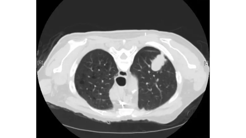 CT scan showing adenocarcinoma lung cancer in a never smoker — most common type of lung cancer that causes lung cancer in non-smoking patients