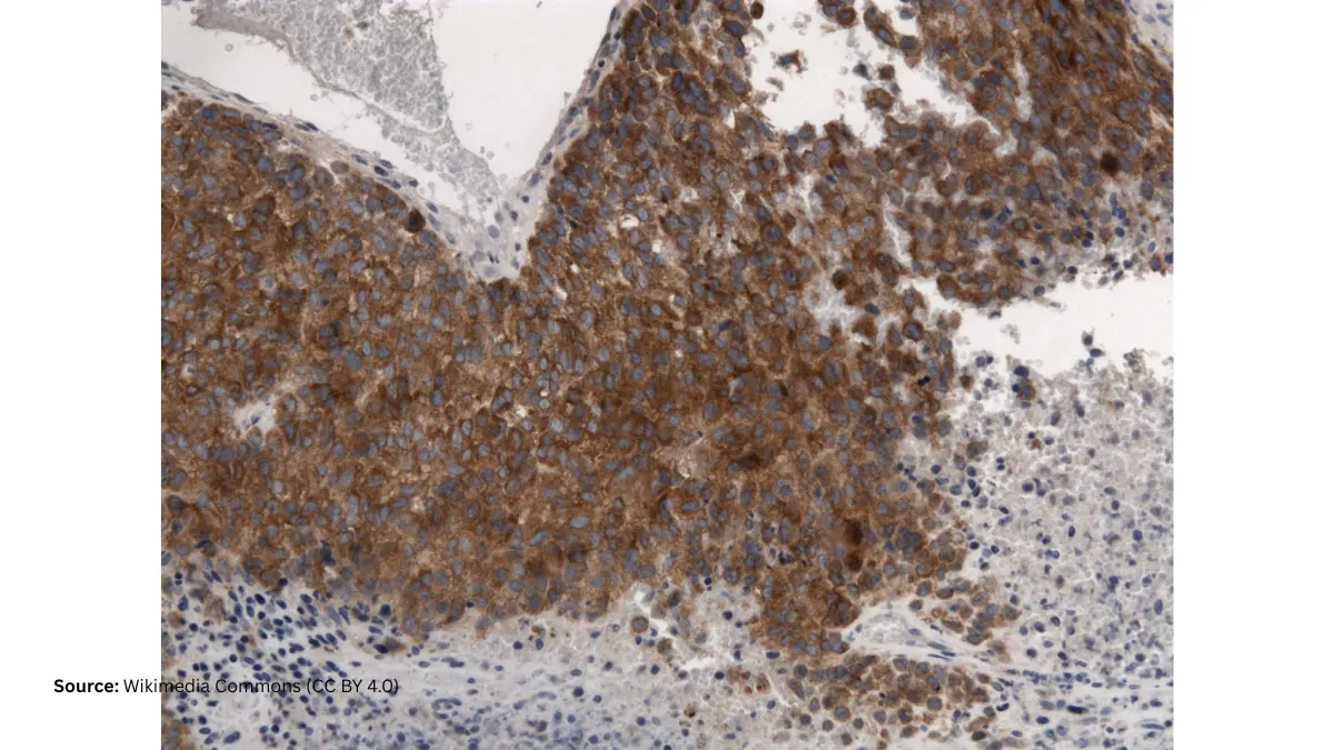 BRAF-targeted therapy BRAF V600E mutant melanoma histopathology microscopy image showing cancer cells targeted by FDA-approved inhibitor drugs