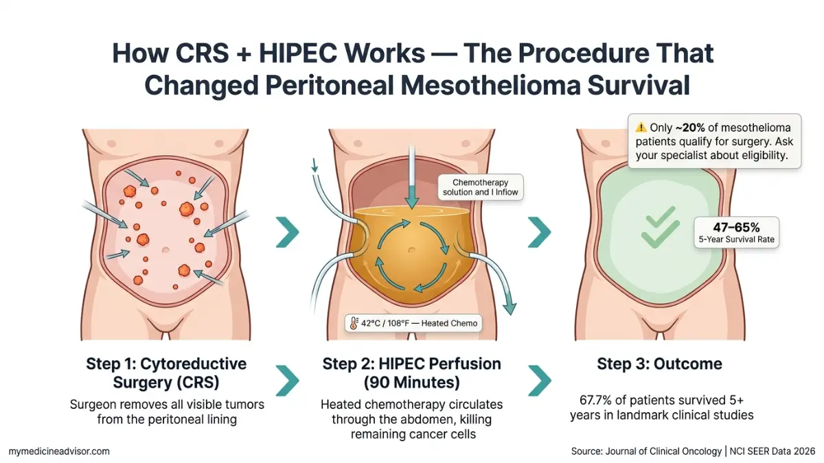 Mesothelioma Prognosis HIPEC procedure diagram showing cytoreductive surgery and heated chemotherapy process