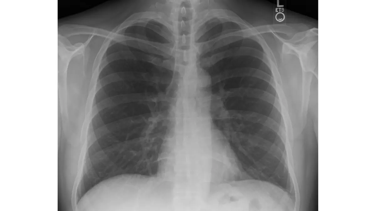 Early signs of lung cancer investigated through chest X-ray — normal posteroanterior PA chest radiograph showing lung fields, heart silhouette, and rib cage as the first diagnostic imaging test ordered by doctors