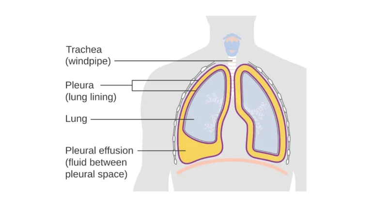 Early signs of lung cancer including pleural effusion causing shortness of breath — fluid buildup in the lung lining shown in clinical CRUK diagram