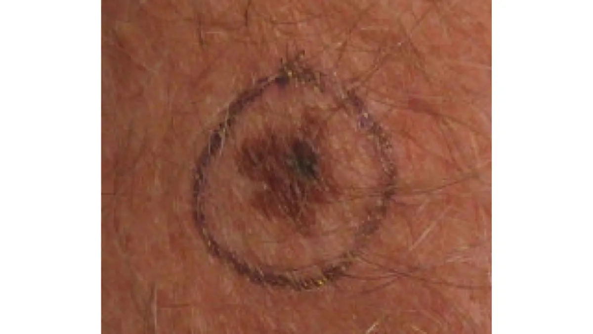 How to prevent melanoma — clinical photograph of malignant melanoma in situ on the left forearm showing ABCDE warning signs including asymmetry, irregular border, and multi-tone color variation for monthly skin self-examination