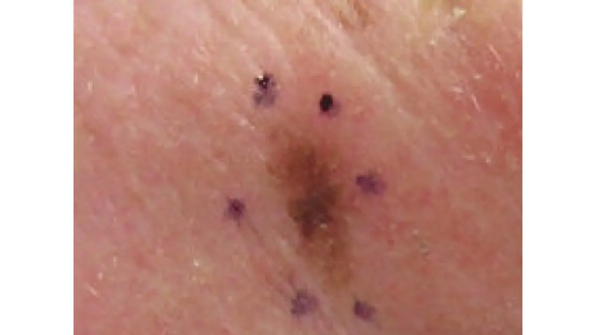 How to prevent melanoma — clinical photograph of Lentigo Maligna Melanoma on the cheek caused by chronic UV sun exposure, showing irregular pigmentation across sun-damaged skin