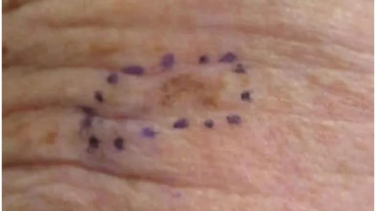 How to prevent melanoma — clinical photograph of early-stage melanoma in situ on the right forehead showing irregular pigmentation and border irregularity