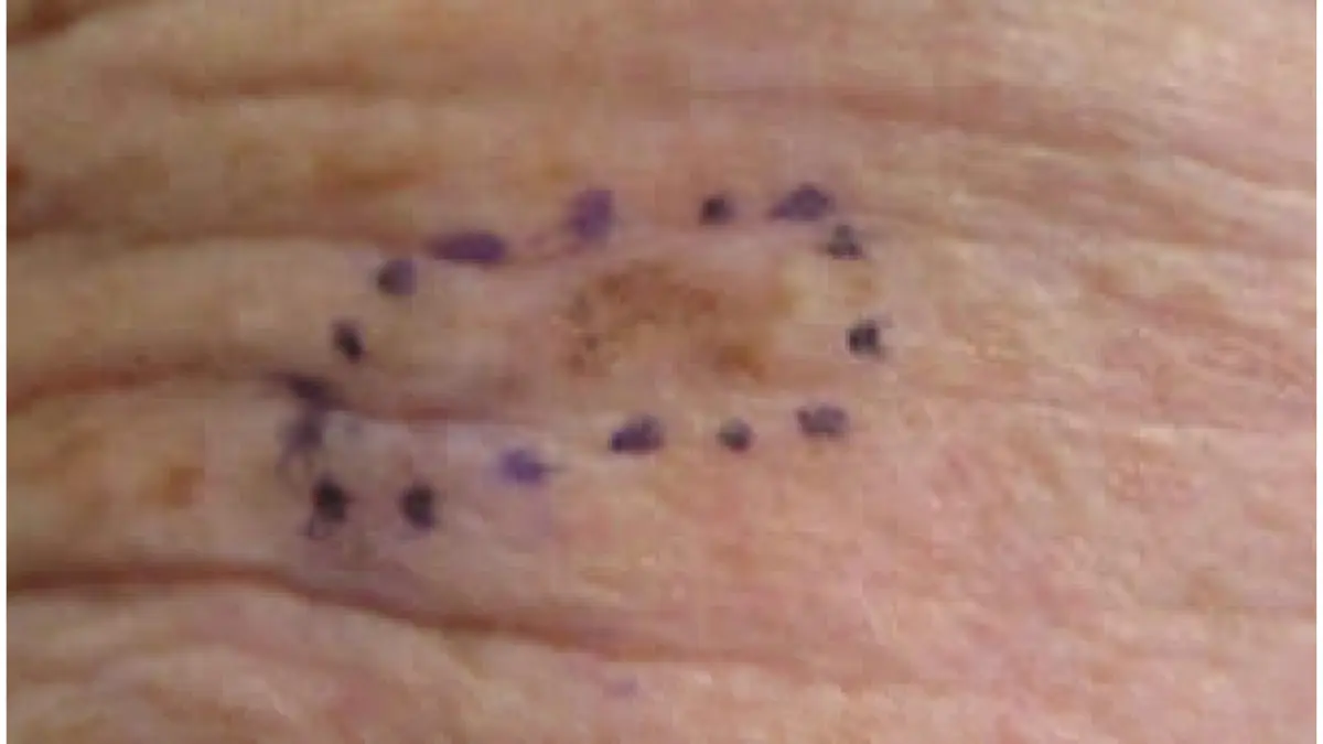 How to prevent melanoma — clinical photograph of early-stage melanoma in situ on the right forehead showing irregular pigmentation and border irregularity
