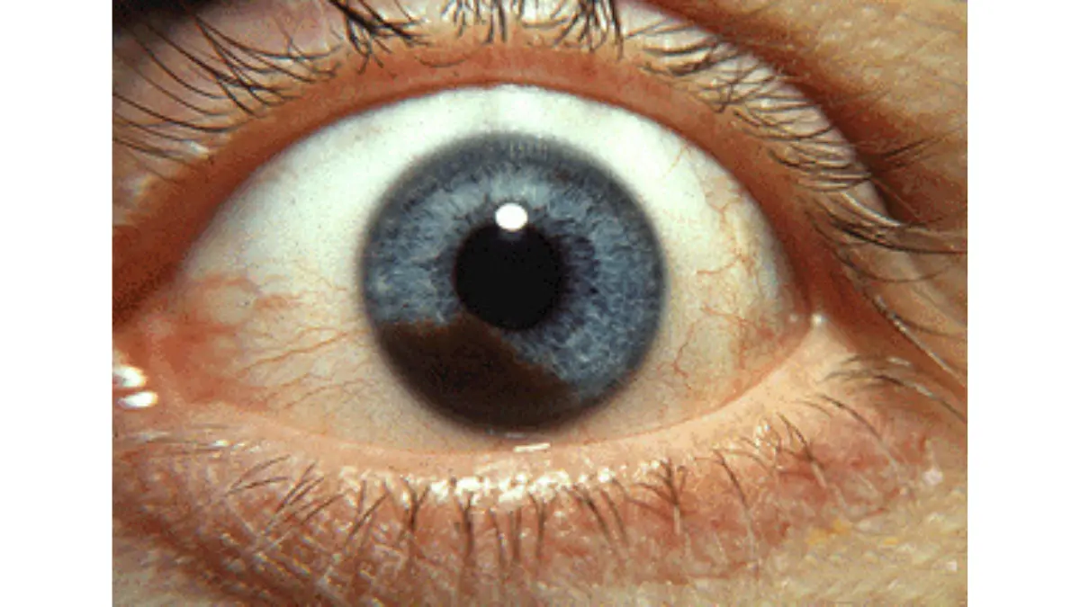 Clinical photograph of iris melanoma — a dark pigmented mass on the colored part of the eye, showing how uveal melanoma appears when it develops in the iris