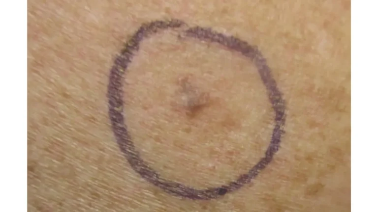 Life after melanoma — malignant melanoma on right posterior shoulder, one of the most common locations requiring lifelong skin monitoring and follow-up care after treatment