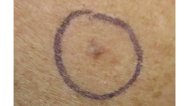 Life after melanoma — malignant melanoma on right posterior shoulder, one of the most common locations requiring lifelong skin monitoring and follow-up care after treatment
