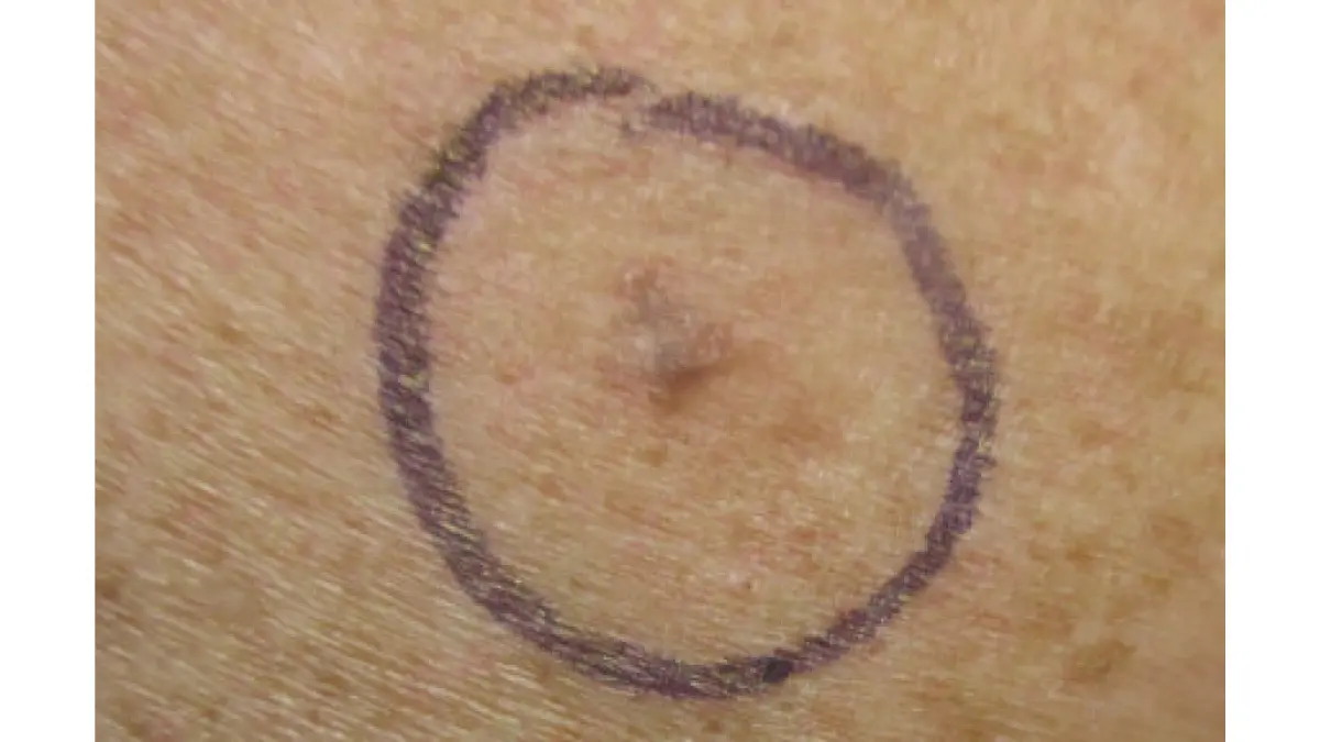 Life after melanoma — malignant melanoma on right posterior shoulder, one of the most common locations requiring lifelong skin monitoring and follow-up care after treatment