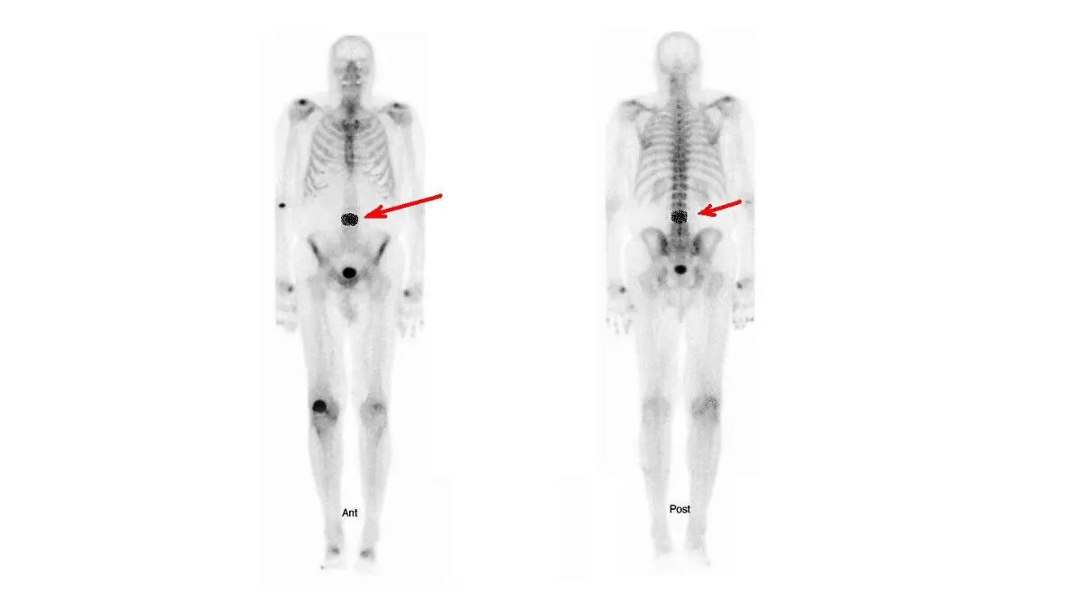 Medical illustration of cancer metastasis inside a vertebral bone body showing the mechanism of advanced lung cancer back pain through spinal bone spread and nerve compression