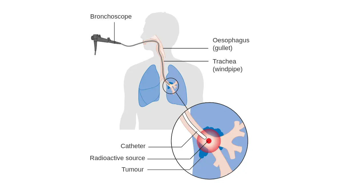 Diagram showing how internal radiotherapy brachytherapy is administered for lung cancer treatment through bronchoscope placement