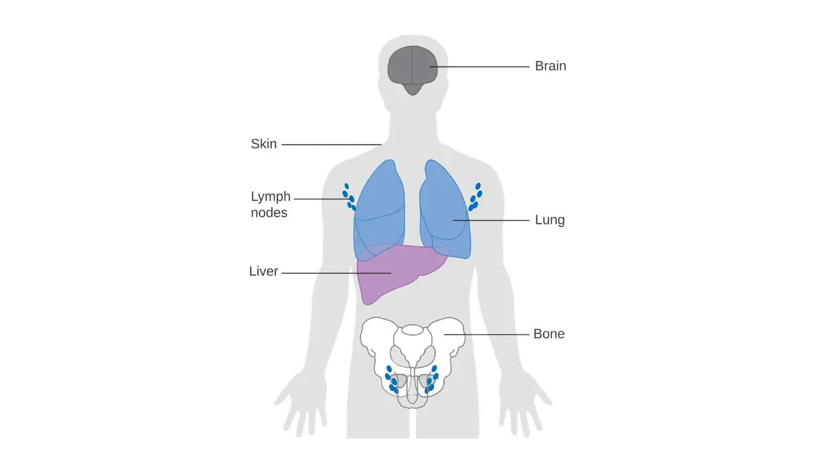 CRUK body diagram showing common cancer metastasis sites including brain, bones, and liver — illustrates the life-threatening consequences of ignoring a persistent cough as an early sign of lung cancer and missing the window for early detection