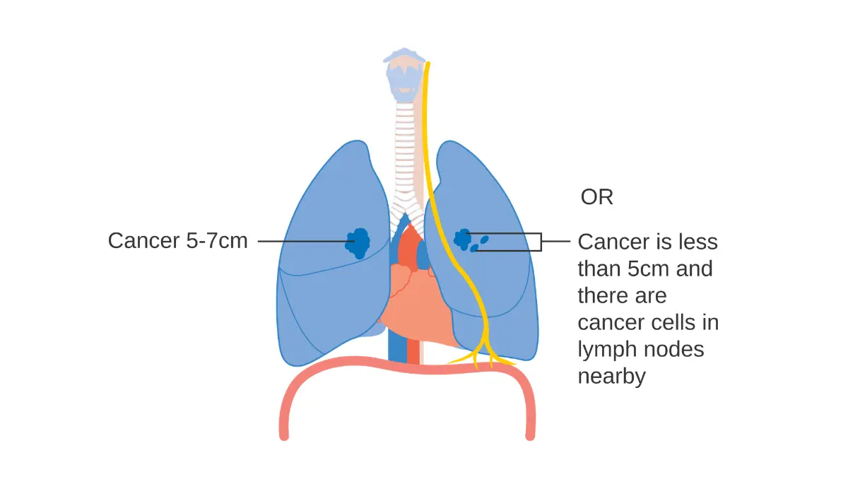 Lung cancer stages Stage 2A diagram showing tumor with early lymph node involvement near the lung hilum and bronchus