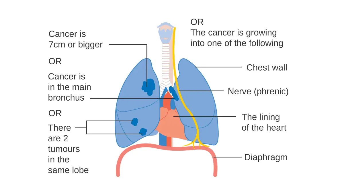 Lung cancer stages progression diagram showing Stage 2B tumor invading the chest wall and nearby structures illustrating how cancer advances between stages