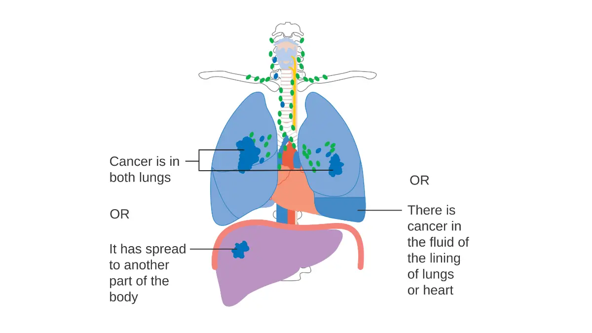 Diagram showing stage 4 lung cancer spread to distant organs including brain, liver, adrenal glands, and bones illustrating metastatic lung cancer