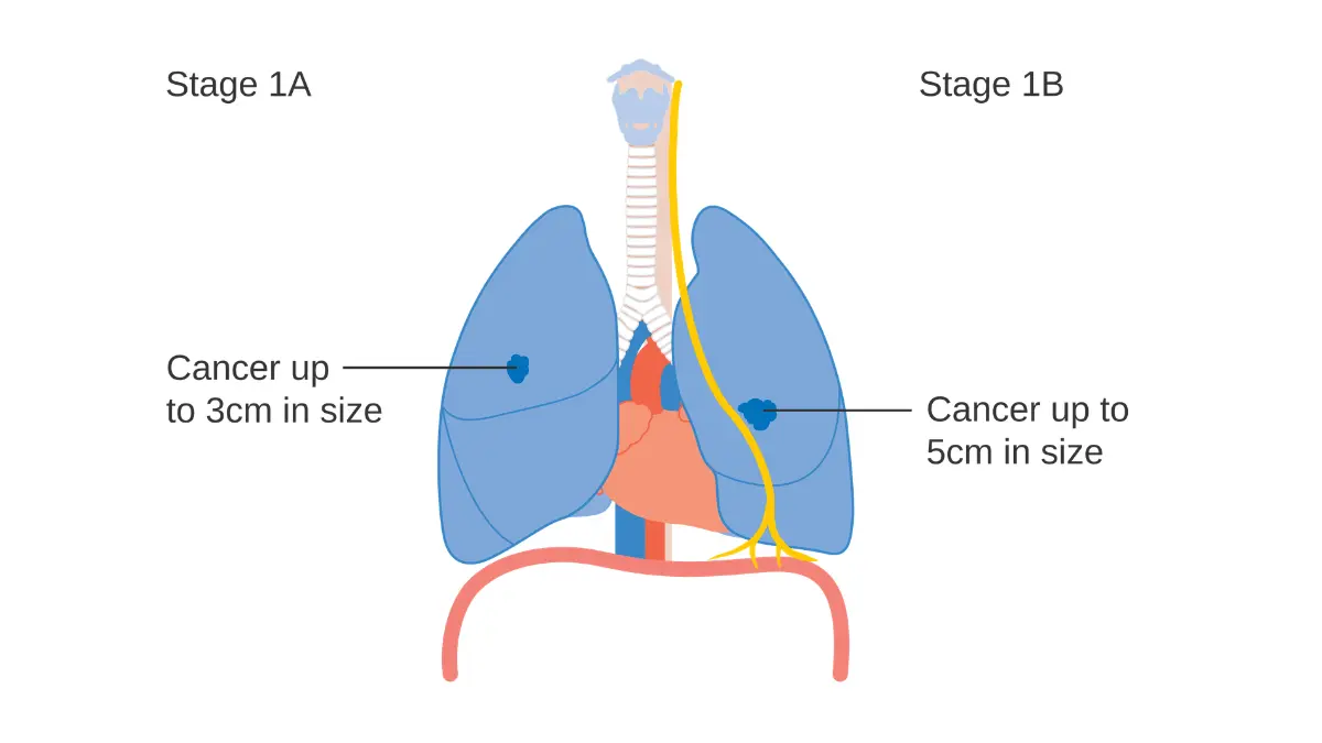 Lung cancer stages 1A and 1B diagram showing tumor size and location confined within the lung with no lymph node involvement