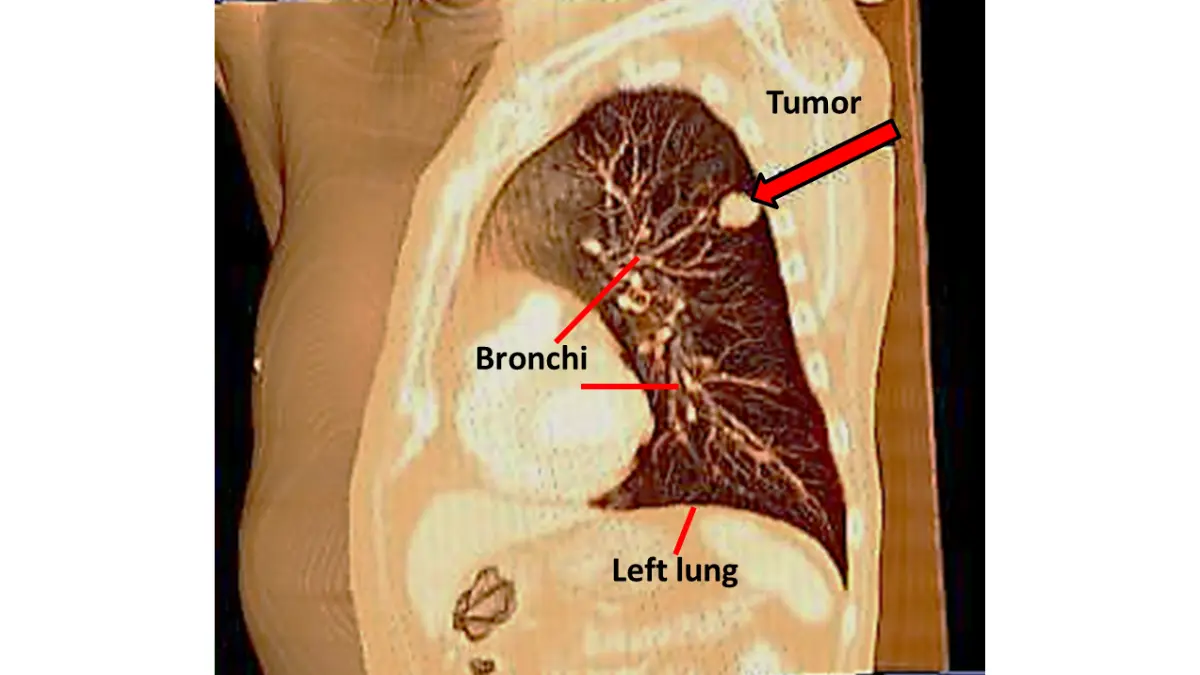 3D CT volume rendering showing a tumor in the left lung — the type of advanced imaging used in LDCT lung cancer screening programs recommended for women at elevated risk, showing how lung cancer symptoms in women are identified through imaging