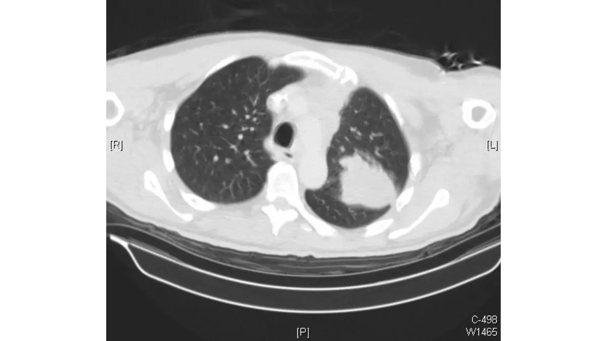 CT scan image showing pulmonary adenocarcinoma in the left lung — the peripheral tumor type most associated with lung cancer symptoms in women who have never smoked